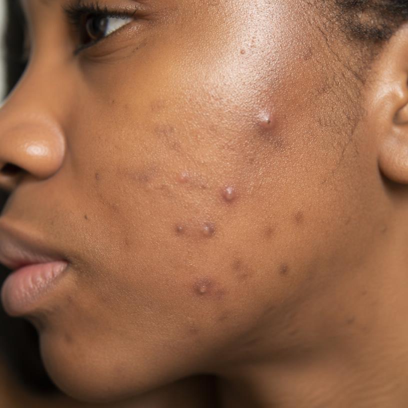 Acne & Breakouts